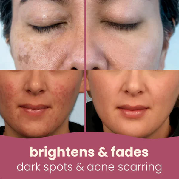 Turmeric & Kojic Acid Natural Soap for Dark Spots